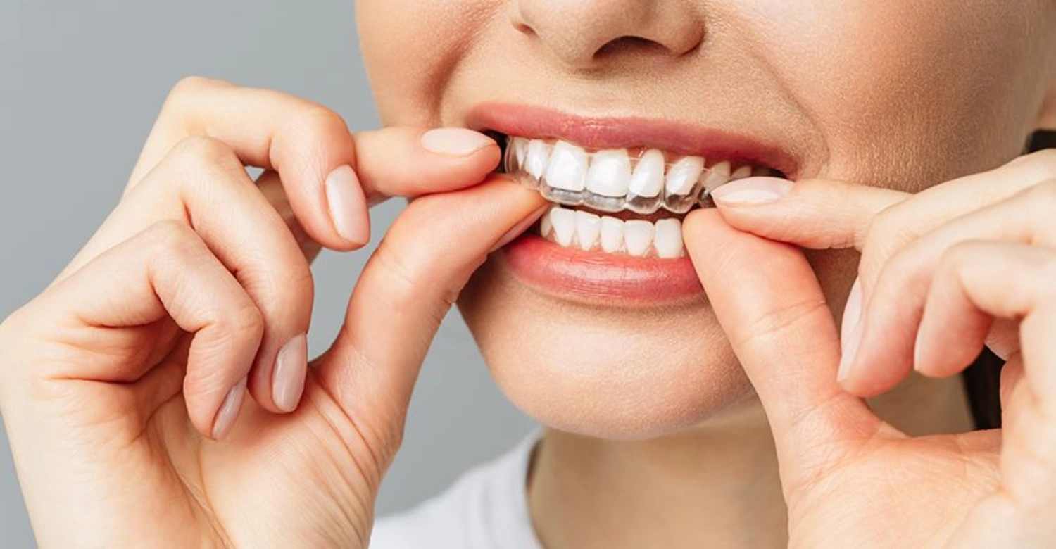aligner therapy